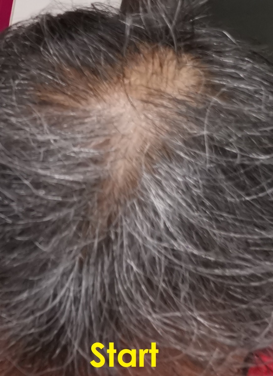 RS Hair Start A
